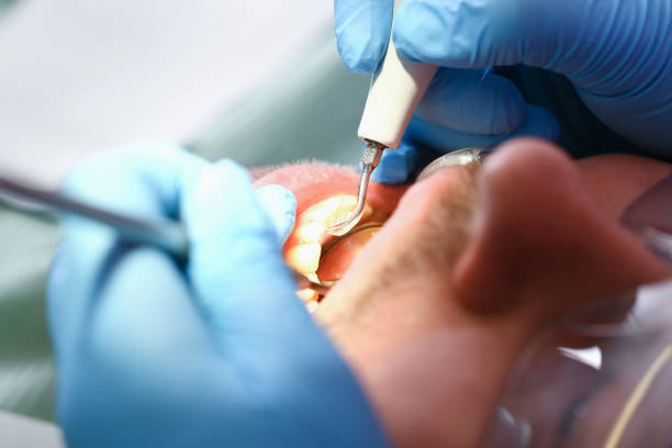 Best Emergency Dental Extractions in Tuscumbia, AL